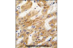 Formalin-fixed and paraffin-embedded human hepatocarcinoma tissue reacted with ALDH4A1 antibody , which was peroxidase-conjugated to the secondary antibody, followed by DAB staining. (ALDH4A1 antibody  (C-Term))