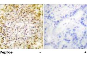 Immunohistochemical analysis of paraffin-embedded human lung carcinoma tissue using CCNH polyclonal antibody . (Cyclin H antibody)