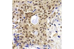 Immunohistochemistry of paraffin-embedded human oophoroma using PHF19 antibody (ABIN5975738) at dilution of 1/100 (40x lens). (PHF19 antibody)