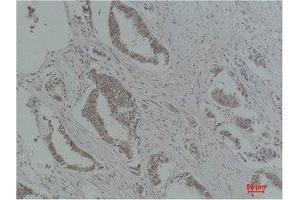 Immunohistochemistry (IHC) analysis of paraffin-embedded Human Breast Carcinoma using p21 Polyclonal Antibody. (p21 antibody)