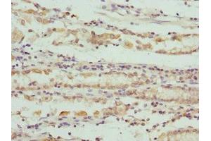 Immunohistochemistry of paraffin-embedded human gastric cancer using ABIN7166101 at dilution of 1:100 (SCO2 antibody  (AA 1-130))