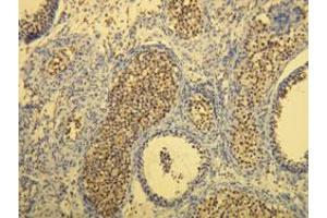 Immunohistochemical staining (Formalin-fixed paraffin-embedded sections) of human seminoma with KIT monoclonal antibody, clone R21-V . (KIT antibody  (C-Term))
