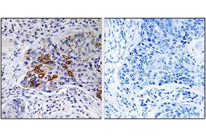 Immunohistochemistry analysis of paraffin-embedded human lung carcinoma tissue, using ADCY9 antibody.