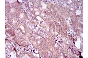 Immunohistochemical analysis of paraffin-embedded cervical cancer tissues using EGFR mutant mouse mAb with DAB staining. (EGFR Mutant (AA 693-893), (Mutant) antibody)