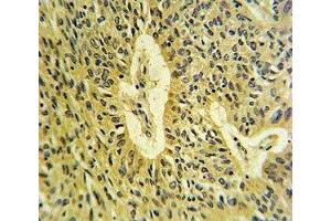 SMAD7 antibody IHC analysis in formalin fixed and paraffin embedded lung carcinoma. (SMAD7 antibody  (AA 195-224))