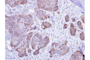 IHC-P Image Immunohistochemical analysis of paraffin-embedded Cal27 xenograft , using Calsequestrin-2, antibody at 1:500 dilution. (CASQ2 antibody)