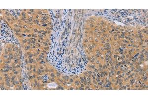 Immunohistochemistry of paraffin-embedded Human cervical cancer using BRS3 Polyclonal Antibody at dilution of 1:50