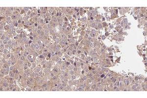 ABIN6275975 at 1/100 staining Human liver cancer tissue by IHC-P.