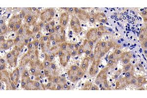 Detection of SAA in Human liver cirrhosis Tissue using Polyclonal Antibody to Serum Amyloid A (SAA) (SAA antibody  (AA 19-122))