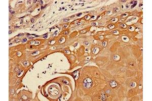 Immunohistochemistry of paraffin-embedded human ovarian cancer using ABIN7174048 at dilution of 1:100 (TIE1 antibody  (AA 217-328))