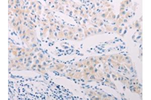 The image on the left is immunohistochemistry of paraffin-embedded Human lung cancer tissue using ABIN7189656(ADAMTS17 Antibody) at dilution 1/60, on the right is treated with synthetic peptide. (ADAMTS17 antibody)