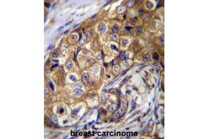 CTAGE5 Antibody (C-term) immunohistochemistry analysis in formalin fixed and paraffin embedded human breast carcinoma followed by peroxidase conjugation of the secondary antibody and DAB staining.