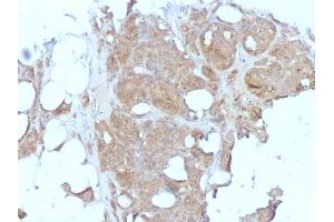 Formalin-fixed, paraffin-embedded human Breast Carcinoma stained with MVP Monoclonal Antibody (1032). (MVP antibody)