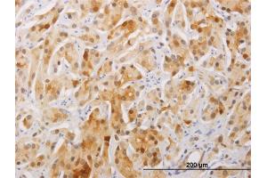 Immunoperoxidase of monoclonal antibody to FAM84A on formalin-fixed paraffin-embedded human prostate cancer.