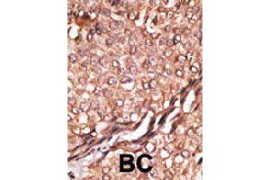 Formalin-fixed and paraffin-embedded human breast cancer tissue reacted with BAIAP2 polyclonal antibody  , which was peroxidase-conjugated to the secondary antibody, followed by AEC staining. (BAIAP2 antibody  (C-Term))