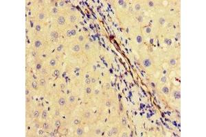 Immunohistochemistry of paraffin-embedded human liver cancer using ABIN7174393 at dilution of 1:100 (OTUB1 antibody  (AA 2-201))
