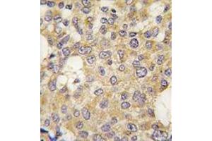 Formalin-fixed and paraffin-embedded human breast carcinoma tissue reacted with Parg antibody (C-term) , which was peroxidase-conjugated to the secondary antibody, followed by DAB staining. (PARG antibody  (C-Term))