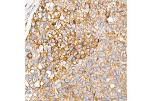 Immunohistochemistry of paraffin-embedded human esophageal cancer using PLOD3 Rabbit mAb (ABIN7269530) at dilution of 1:1600 (40x lens). (PLOD3 antibody)
