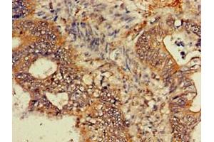 Immunohistochemistry of paraffin-embedded human colon cancer using ABIN7154741 at dilution of 1:100 (GNB4 antibody  (AA 105-185))