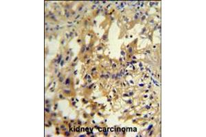 UPP2 antibody immunohistochemistry analysis in formalin fixed and paraffin embedded human kidney carcinoma followed by peroxidase conjugation of the secondary antibody and DAB staining. (UPP2 antibody  (C-Term))