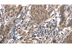 Immunohistochemistry of paraffin-embedded Human gasrtic cancer tissue using ALOX15 Polyclonal Antibody at dilution 1:50 (ALOX15 antibody)