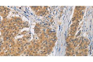 Immunohistochemistry of paraffin-embedded Human gasrtic cancer tissue using FASTK Polyclonal Antibody at dilution 1:30 (FASTK antibody)