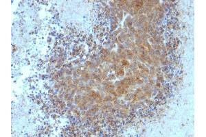 Formalin-fixed, paraffin-embedded human Melanoma stained with BAX Mouse Monoclonal Antibody (BAX/962). (BAX antibody)