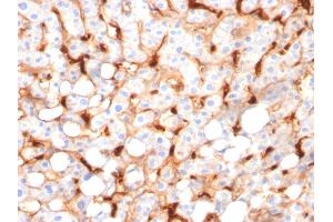 Formalin-fixed, paraffin-embedded human Hepatocellular Carcinoma stained with C1QB Mouse Monoclonal Antibody (C1QB/2966). (C1QB antibody  (AA 41-188))