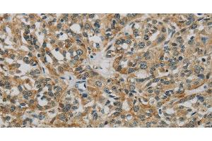 Immunohistochemistry of paraffin-embedded Human esophagus cancer using E2F6 Polyclonal Antibody at dilution of 1:60 (E2F6 antibody)