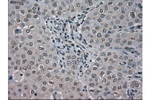 Immunohistochemical staining of paraffin-embedded Adenocarcinoma of colon tissue using anti-BUB1Bmouse monoclonal antibody. (BUB1B antibody)