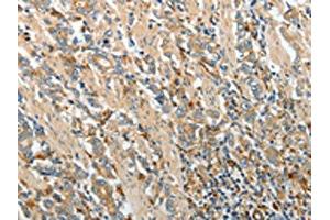 The image on the left is immunohistochemistry of paraffin-embedded Human gastric cancer tissue using ABIN7130695(PRCP Antibody) at dilution 1/20, on the right is treated with fusion protein. (PRCP antibody)