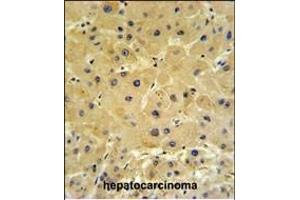 IFT20 Antibody (Center)  IHC analysis in formalin fixed and paraffin embedded hepatocarcinoma followed by peroxidase conjugation of the secondary antibody and DAB staining. (IFT20 antibody  (Center))