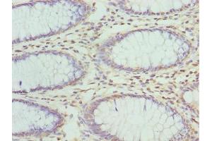 Immunohistochemistry of paraffin-embedded human colon cancer using ABIN7176343 at dilution of 1:100 (ZNF546 antibody  (AA 101-400))