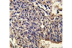 IHC analysis of FFPE human lung carcinoma stained with IL-1 antibody (IL1A antibody  (AA 177-206))