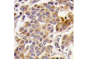 Formalin-fixed and paraffin-embedded human breast carcinoma tissue reacted with PRKAA1, which was peroxidase-conjugated to the secondary antibody, followed by DAB staining. (PRKAA1 antibody  (Ser487))