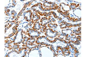 The image on the left is immunohistochemistry of paraffin-embedded Human thyroid cancer tissue using (TLR2 Antibody) at dilution 1/30, on the right is treated with fusion protein. (TLR2 antibody)