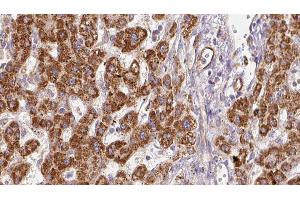 ABIN6278182 at 1/100 staining Human liver cancer tissue by IHC-P. (P2RX7 antibody  (C-Term))