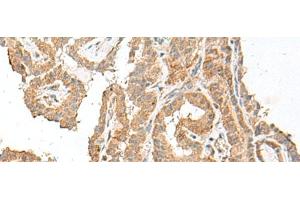 Immunohistochemistry of paraffin-embedded Human thyroid cancer tissue using GART Polyclonal Antibody at dilution of 1:30(x200) (GART antibody)