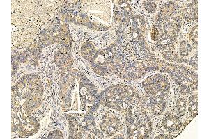 ABIN7095635 and ABIN7099697 at 1/100 staining human liver cancer and adjacent non-tumor tissue by IHC-P. (PDZK1 Interacting Protein 1 (PDZK1IP1) antibody)