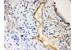 Anti- P2X2 Picoband antibody, IHC(P) IHC(P): Human Lung Cancer Tissue (P2RX2 antibody  (AA 139-471))