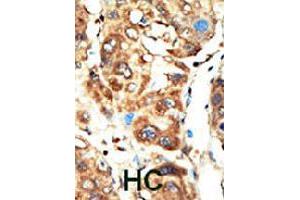 Formalin-fixed and paraffin-embedded human hepatocellular carcinoma tissue reacted with MAGI1 polyclonal antibody  , which was peroxidase-conjugated to the secondary antibody, followed by AEC staining. (MAGI1 antibody  (C-Term))