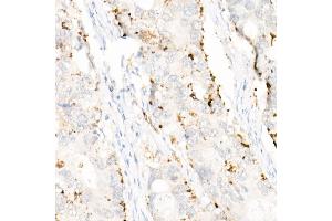 Immunohistochemistry of paraffin-embedded human colon carcinoma using Perilipin-2 antibody (ABIN7269220) at dilution of 1:1600 (40x lens). (ADRP antibody)