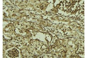 ABIN6267212 at 1/100 staining Human breast cancer tissue by IHC-P.