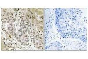 Immunohistochemistry analysis of paraffin-embedded human lung carcinoma tissue, using STK36 antibody. (STK36 antibody)