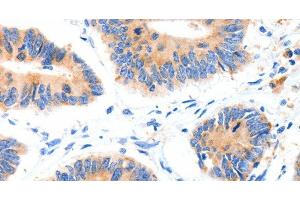 Immunohistochemistry of paraffin-embedded Human colon cancer tissue using GLUT-4 Polyclonal Antibody at dilution 1:70 (GLUT4 antibody)