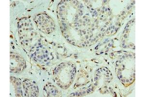 Immunohistochemistry of paraffin-embedded human breast cancer using ABIN7152130 at dilution of 1:100 (EIF1AX antibody  (AA 10-144))
