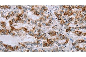 Immunohistochemistry of paraffin-embedded Human liver cancer tissue using NMT1 Polyclonal Antibody at dilution 1:45 (NMT1 antibody)