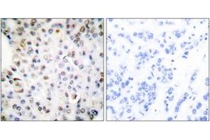 Immunohistochemistry analysis of paraffin-embedded human breast carcinoma tissue, using Retinoid X Receptor gamma Antibody. (Retinoid X Receptor gamma antibody  (AA 171-220))