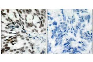 Immunohistochemical analysis of paraffin- embedded human breast carcinoma tissue using Rb (Ab-780) antibody (E021110). (Retinoblastoma 1 antibody)