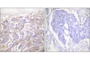 Immunohistochemistry analysis of paraffin-embedded human breast carcinoma tissue, using TNF Receptor I Antibody. (TNFRSF1A antibody  (AA 381-430))